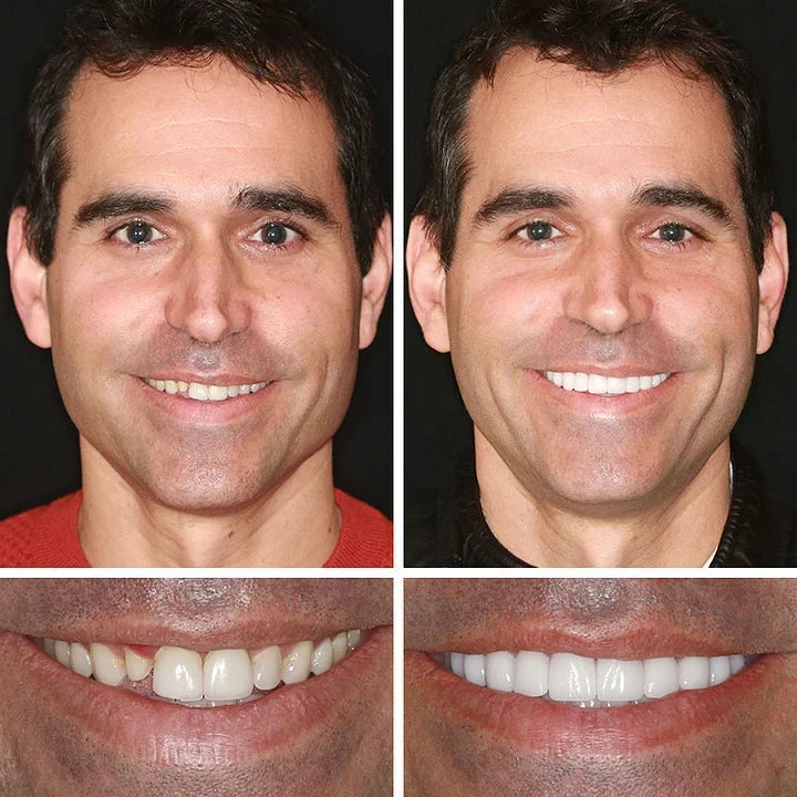 -Ends Today: 75% OFF! ⏰DarkFairy™ Medical Full Denture with Strong Suctiond Custom-Fit Full Functional Dentures🦷