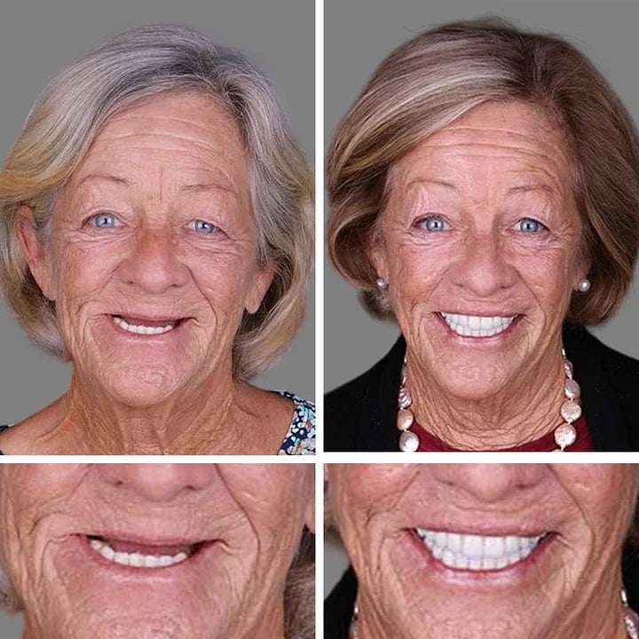 -Ends Today: 75% OFF! ⏰DarkFairy™ Medical Full Denture with Strong Suctiond Custom-Fit Full Functional Dentures🦷