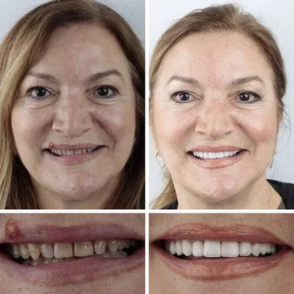 Ends Today: 70% OFF!  🏆2026 Bestselling Product🦷 Fit for a Fresh Smile, Say Goodbye to Wearing Discomfort!🌎