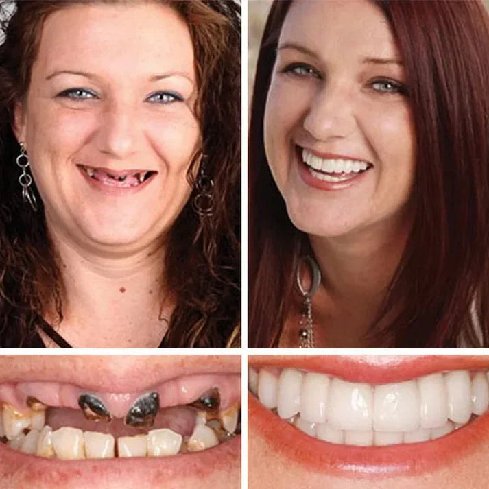 🏆Ends Today: 70% OFF!  🏆2026 Bestselling Product🦷 Fit for a Fresh Smile, Say Goodbye to Wearing Discomfort!🌎