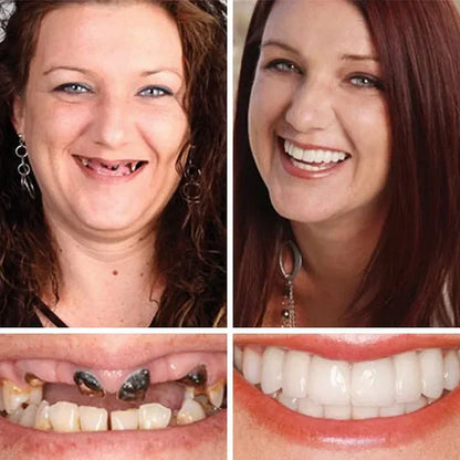 🏆Ends Today: 70% OFF!  🏆2026 Bestselling Product🦷 Fit for a Fresh Smile, Say Goodbye to Wearing Discomfort!🌎
